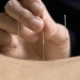 Study shows acupuncture effective for chronic pain